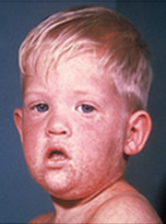 Measles Disease & Vaccine Information - National Vaccine Information ...